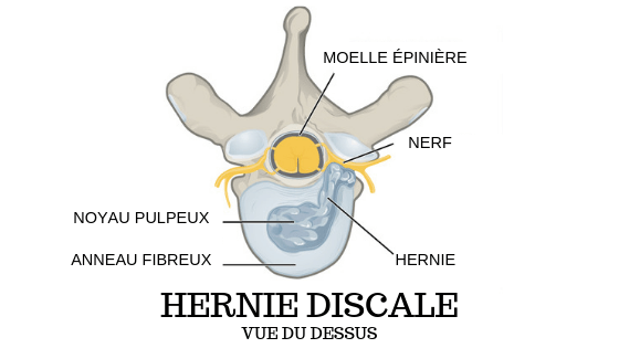 hernie discale cervicale