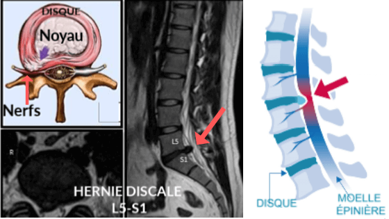 hernie discale L5-S1 IRM