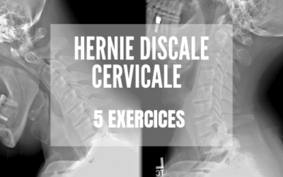 Hernie Discale Cervicale : 5 exercices qui soulagent