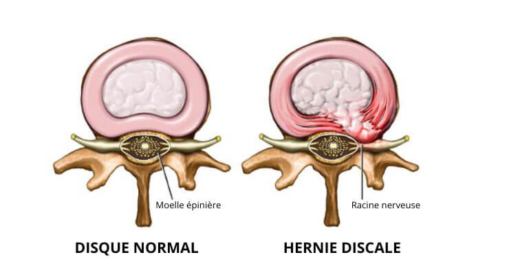 hernie discale et opération