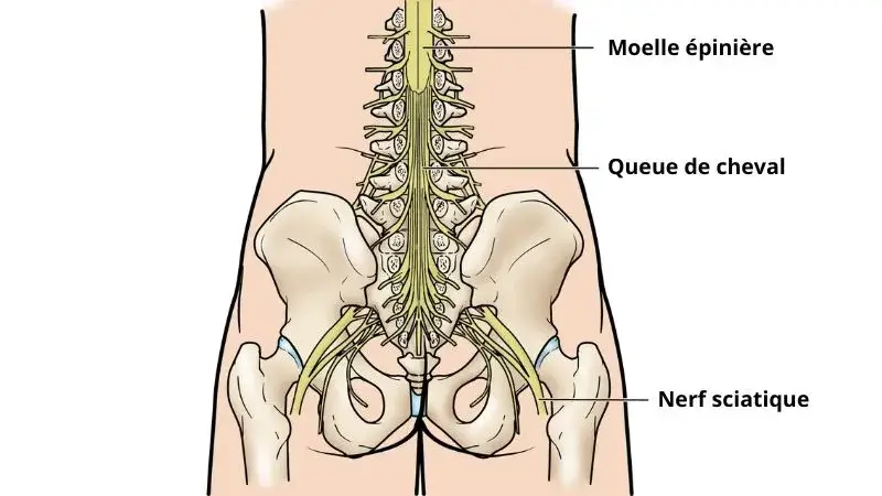 syndrome de la queue de cheval schéma