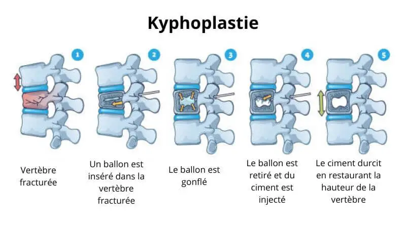 tassement vertébral kyphoplastie