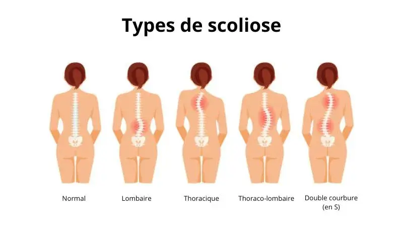 scoliose lombaire types 